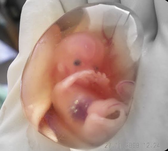 Planned Parenthood: il sospetto di un medico che i bambini abortiti siano tenuti in vita per l’espianto di organi
