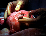 operazione utero